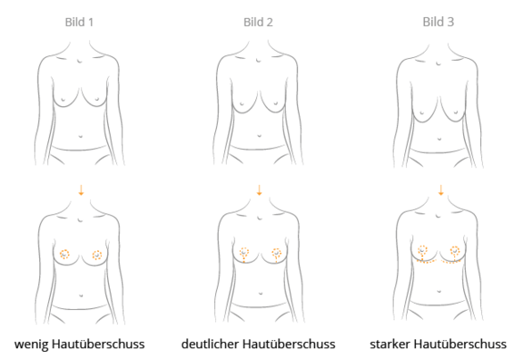 Grafik Bruststraffung, Ästhetik in Dresden