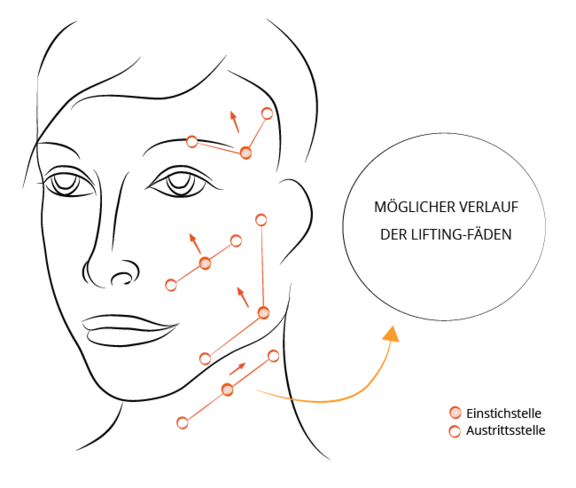 Grafik Fadenlifting, Ästhetik in Dresden