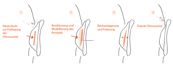 Grafik Ohren anlegen, Ästhetik in Dresden