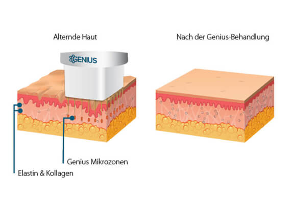 Grafik Genius Behandlung, Ästhetik in Dresden