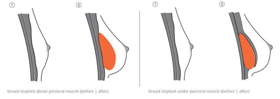 Diagram Breast Enlargement, Ästhetik in Dresden