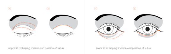 Diagram Eyelid surgery, Ästhetik in Dresden