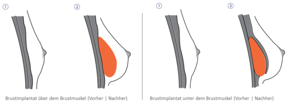 Grafik Brustvergrößerung, Ästhetik in Dresden