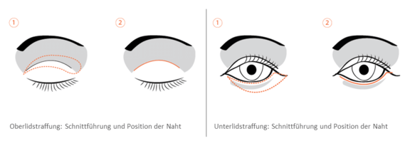 aesthetik-dresden-grafik-lidstraffung.png 