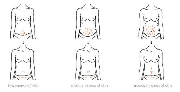 Diagram Abdominoplasty, Ästhetik in Dresden