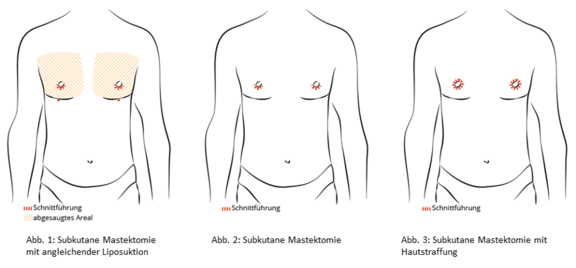 Grafik Gynäkomastie, Ästhetik in Dresden