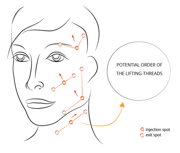 Diagram Thread Lifiting, Ästhetik in Dresden