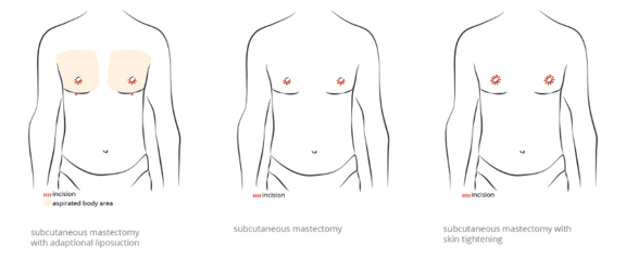 Diagram Gynecomastia, Ästhetik in Dresden