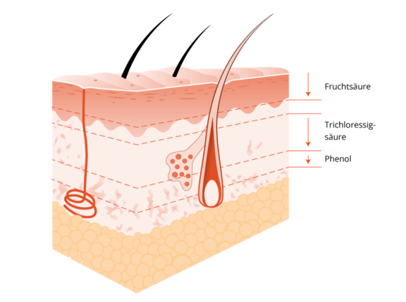 Grafik Phenolpeeling, Ästhetik in Dresden